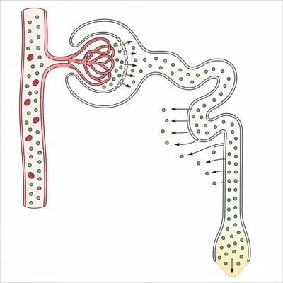 Excess blood glucose overwhelms kidney reabsorption and glucose appears in urine.