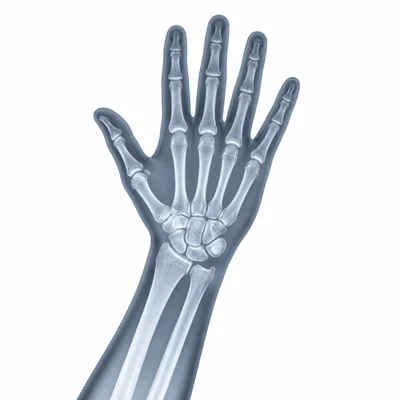 X-ray imaging reveals bones inside a hand or forearm.